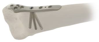 Locking Small Fragment