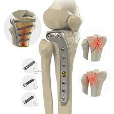 Locking Large Fragment