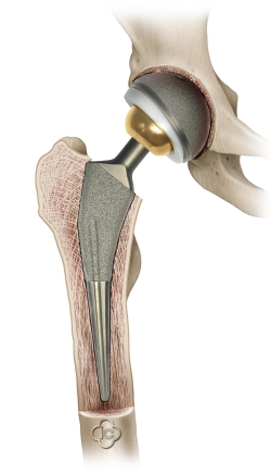 Hip Prosthesis