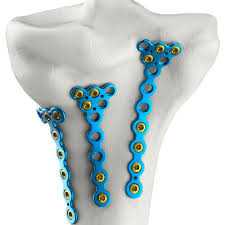 Locking Plate System