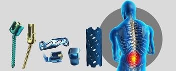 Spinal Implants